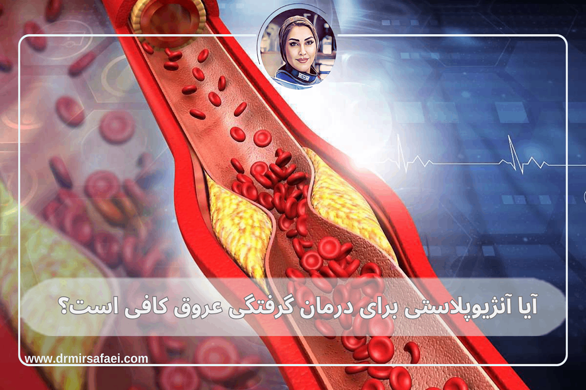آیا آنژیوپلاستی برای درمان گرفتگی عروق کافی است؟